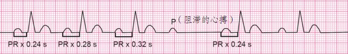 纯干货，图文解析读心电图的9个步骤