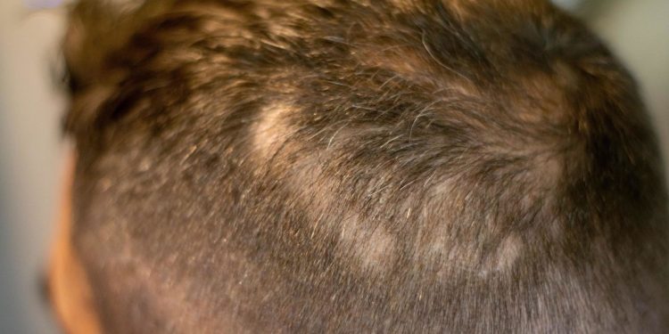 秃头者的福音，科学家发现刺激头发生长分子，小白鼠已实验成果